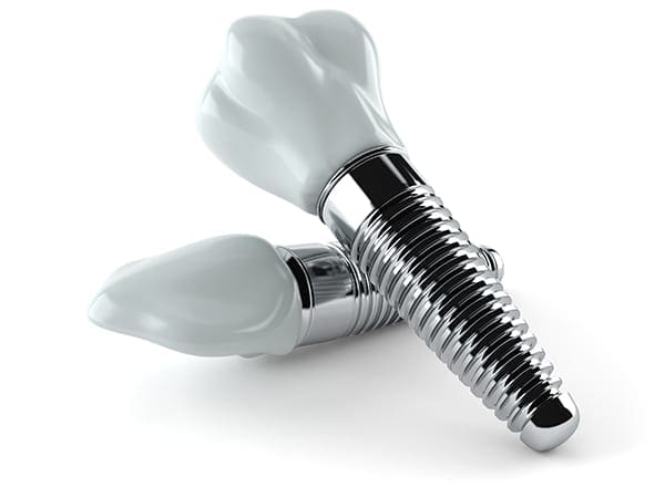 Dental Implants